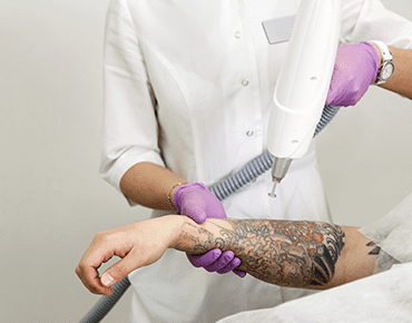 Professional tattoo removal treatment at Cosmo Graft Hair Transplant Centre in Hyderabad, India.